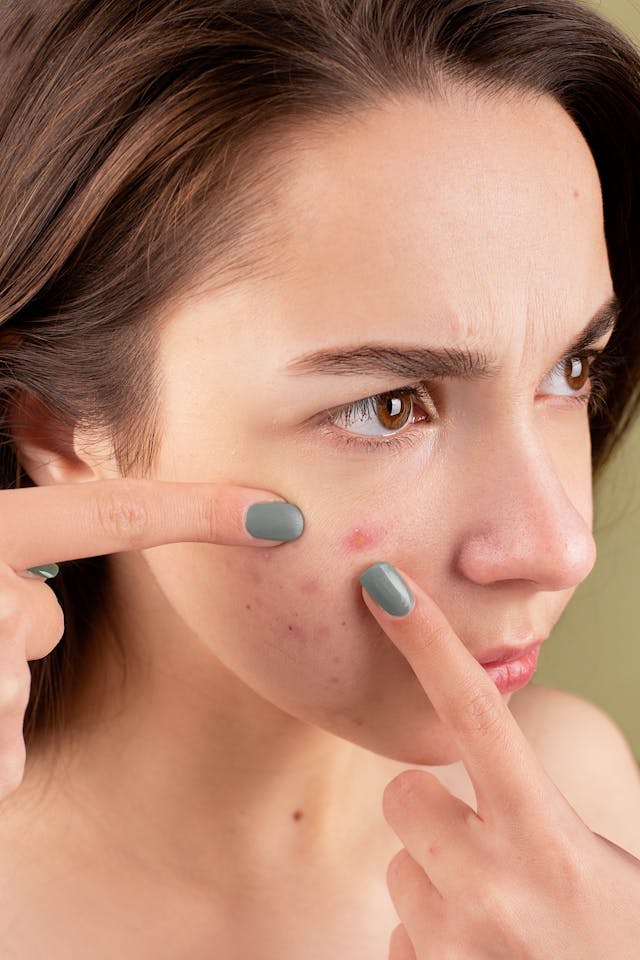 Can Ashwagandha Cause Acne, Hormonal acne breakout on female jawline potentially linked to supplements