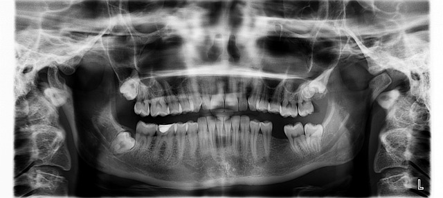 Impacted Wisdom Tooth